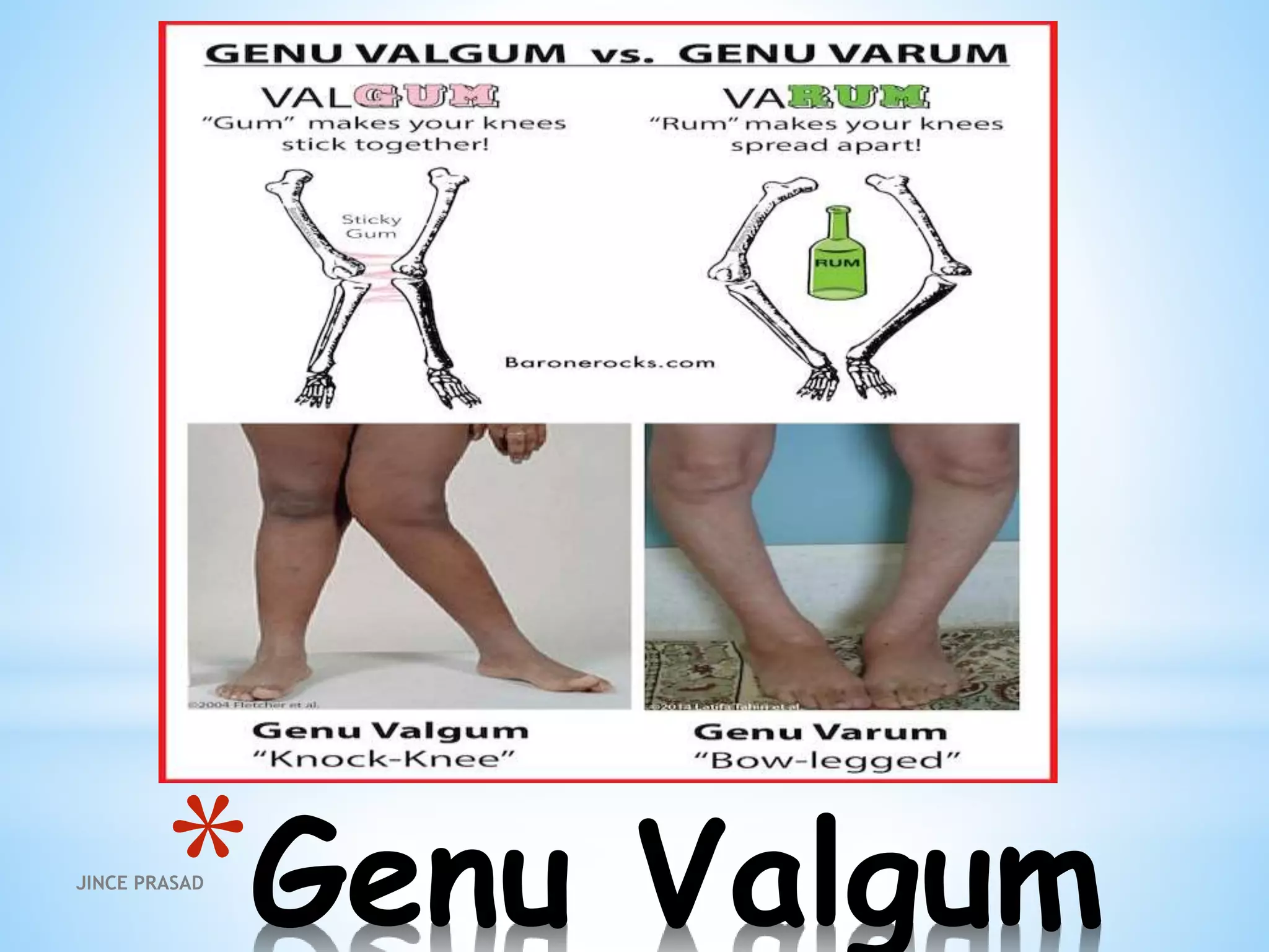 *Genu ValgumJINCE PRASAD
 