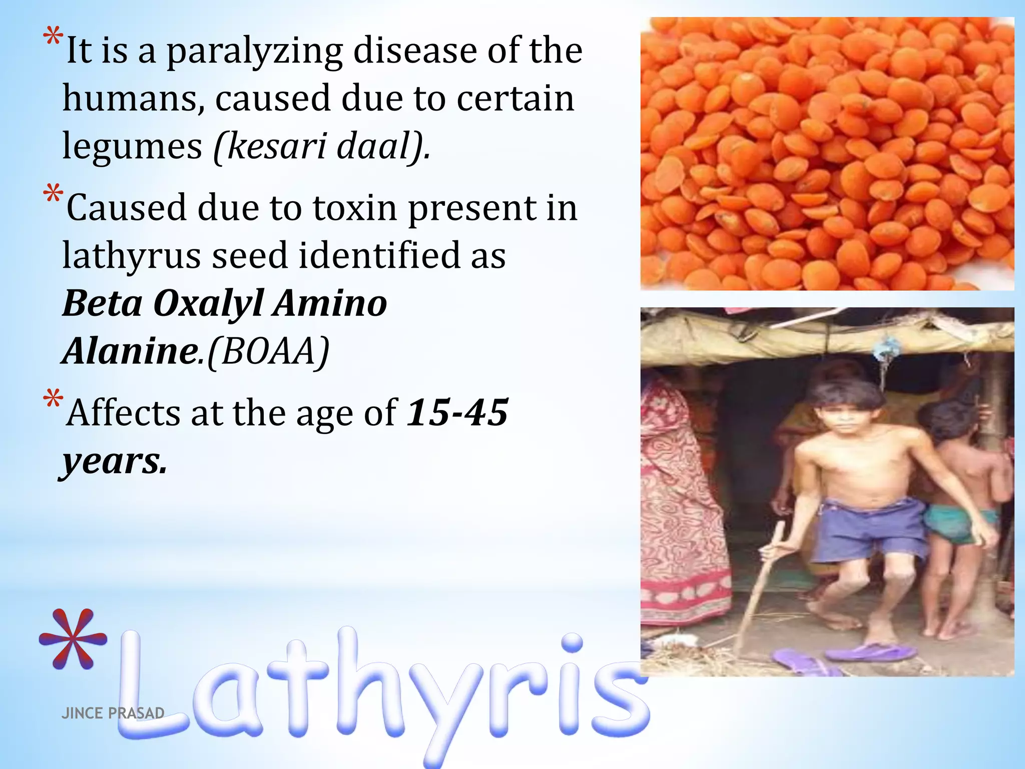 *It is a paralyzing disease of the
humans, caused due to certain
legumes (kesari daal).
*Caused due to toxin present in
lathyrus seed identified as
Beta Oxalyl Amino
Alanine.(BOAA)
*Affects at the age of 15-45
years.
JINCE PRASAD
 
