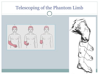 Telescoping of the Phantom Limb
 