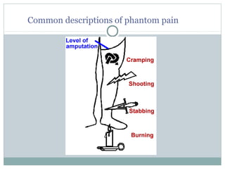 Common descriptions of phantom pain
 