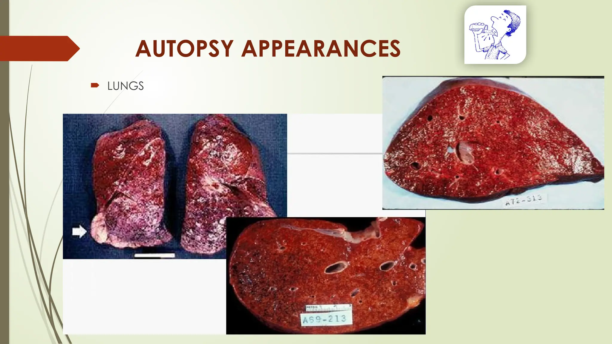 AUTOPSY APPEARANCES
 LUNGS
 
