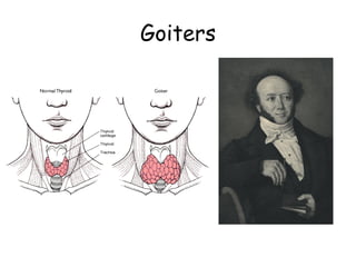 Goiters
 