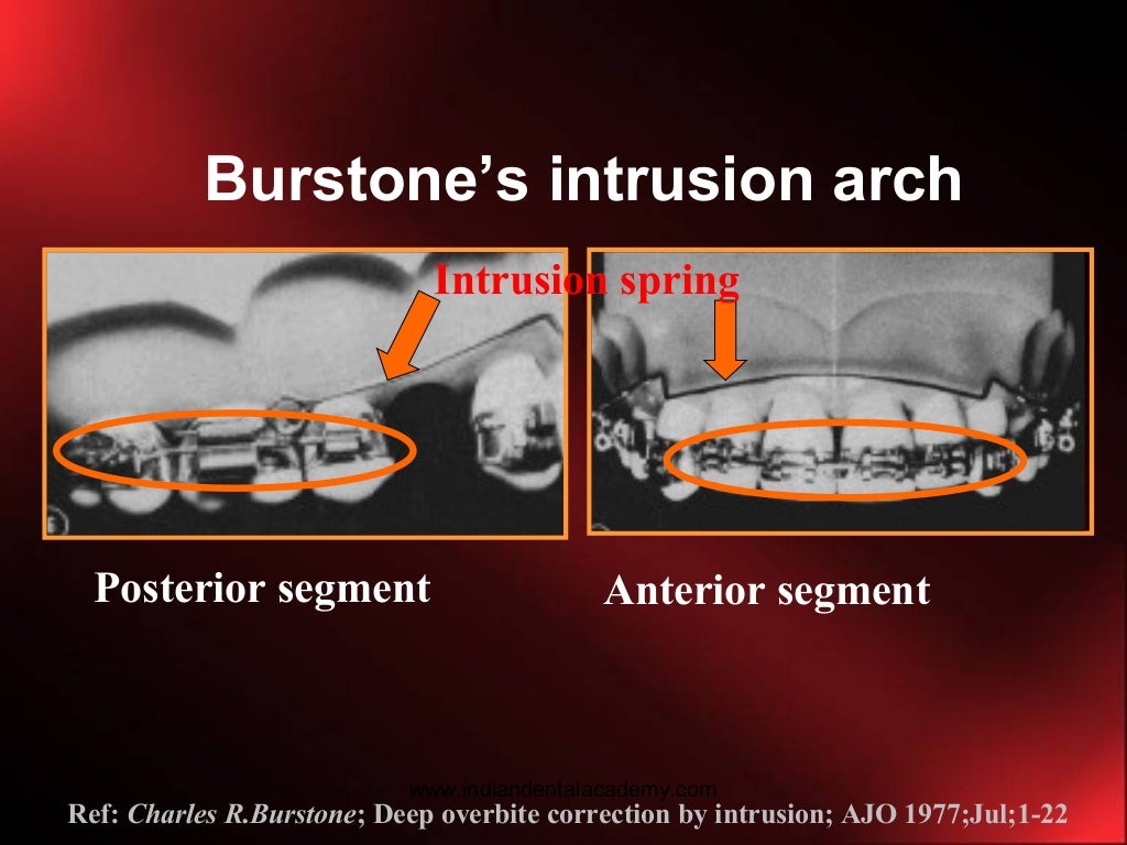 Intrusion in orthodontics /certified fixed orthodontic courses by Ind…
