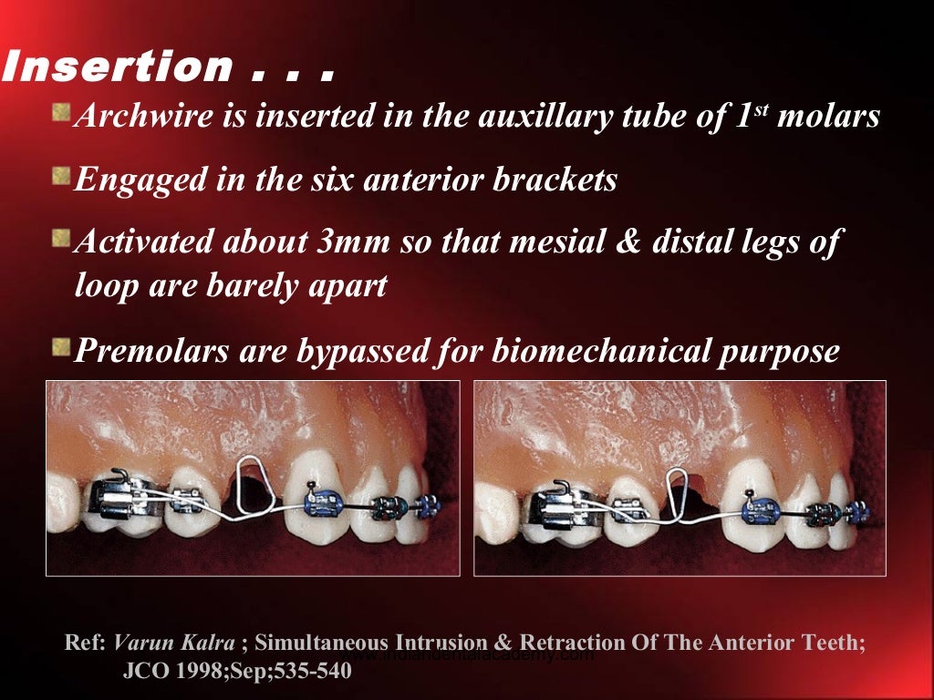 Intrusion in orthodontics /certified fixed orthodontic courses by Ind…