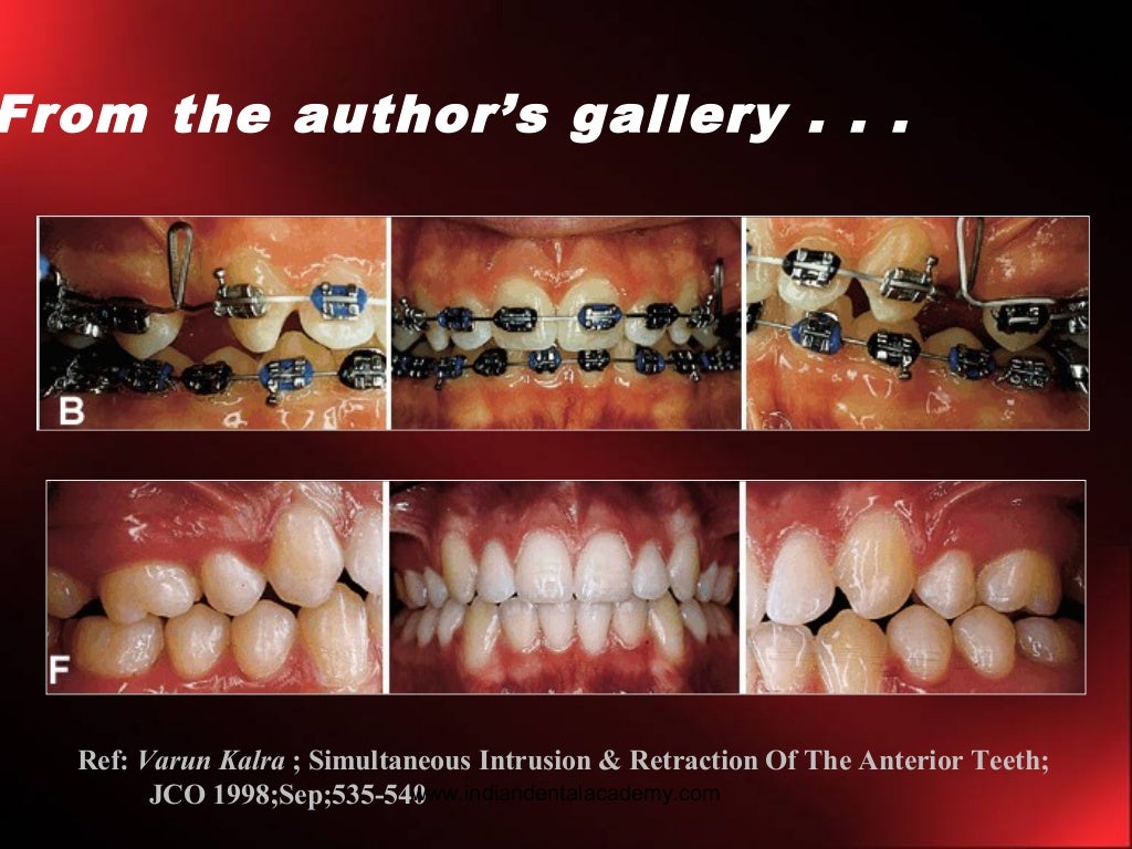 Intrusion in orthodontics /certified fixed orthodontic courses by Ind…