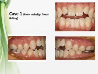 Intrusion and extrusion Invisalign | PPTX