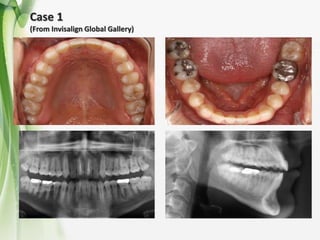 Intrusion and extrusion Invisalign | PPTX