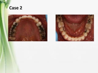 Intrusion and extrusion Invisalign | PPTX