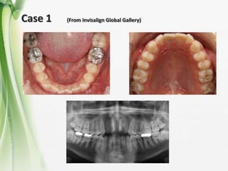 Case 1 (From Invisalign Global Gallery)
 