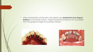  After cementation of the arch, the elastics are stretched to four lingual
buttons on the lower incisors . These should be bonded as far as possible
from the gingival margin to facilitate intrusion
 