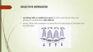 SELECTIVE INTRUSION
 Leveling with a continuous arch or with a sectional wire can
produce undesirable side effects.
 Many times the overbite is corrected not because of intrusion but
by extrusion.
 