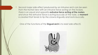  Second major side effect produced by an intrusive arch can be seen
from the frontal view with an intrusive force acting on the incisors,
there is an equal and opposite extrusive force acting at the molars
and since the extrusive force is acting buccaly at the tube, a moment
is created that tends to tip the crowns lingually and roots buccally.
One of the functions of the lingual arch is to resist side effectS.
 