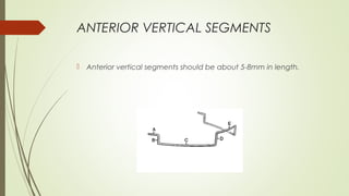 ANTERIOR VERTICAL SEGMENTS
 Anterior vertical segments should be about 5-8mm in length.
 