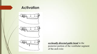 Activation
occlusally directed gable bend in the
posterior portion of the vestibular segment
of the arch wire
 