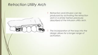 Retraction Utility Arch
 Retraction and intrusion can be
produced by activating the retraction
arch in a similar fashion previously
described of the intrusion utility arch.
 The incorporation of the loop into the
design allows for a longer range of
activation.
 