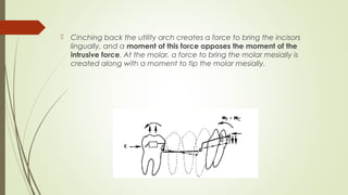 Cinching back the utility arch creates a force to bring the incisors
lingually, and a moment of this force opposes the moment of the
intrusive force. At the molar, a force to bring the molar mesially is
created along with a moment to tip the molar mesially.
 