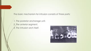 The basic mechanism for intrusion consists of three parts:
1. The posterior anchorage unit.
2. The anterior segment.
3. The intrusion arch itself.
 