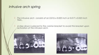 Intrusive arch spring
 The intrusive arch consists of an 0.016 x 0.022 inch or 0.017 x 0.025 inch
TMA..
 A step down is placed to the canine bracket to avoid this bracket upon
activation of the intrusion arch.
 
