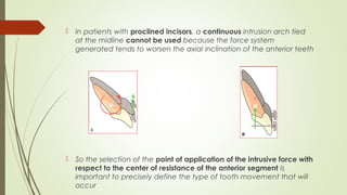  In patients with proclined incisors, a continuous intrusion arch tied
at the midline cannot be used because the force system
generated tends to worsen the axial inclination of the anterior teeth
 So the selection of the point of application of the intrusive force with
respect to the center of resistance of the anterior segment is
important to precisely define the type of tooth movement that will
occur
 