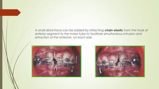 A small distal force can be added by attaching chain elastic from the hook of
anterior segment to the molar tube to facilitate simultaneous intrusion and
retraction of the anteriors on each side
 