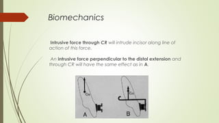 Biomechanics
 Intrusive force through CR will intrude incisor along line of
action of this force. 
An intrusive force perpendicular to the distal extension and
through CR will have the same effect as in A.
 
