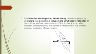  If the intrusive force is placed farther distally and an appropriate
small distal force is applied, intrusion and simultaneous retraction of
the anterior teeth occurs because of the tip back (clockwise)
moment created around the center of resistance of the anterior
segment consisting of four incisors.
 
