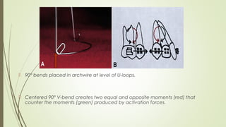  90° bends placed in archwire at level of U-loops.
 Centered 90° V-bend creates two equal and opposite moments (red) that
counter the moments (green) produced by activation forces.
 