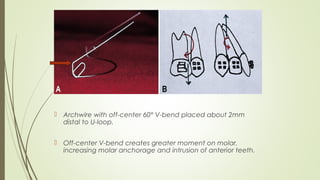  Archwire with off-center 60° V-bend placed about 2mm
distal to U-loop.
 Off-center V-bend creates greater moment on molar,
increasing molar anchorage and intrusion of anterior teeth.
 