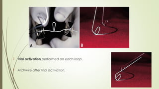  Trial activation performed on each loop..
 Archwire after trial activation.
 