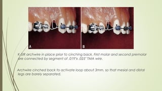 K-SIR archwire in place prior to cinching back. First molar and second premolar
are connected by segment of .019"x .025" TMA wire.
Archwire cinched back to activate loop about 3mm, so that mesial and distal
legs are barely separated.
 