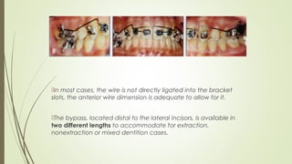 In most cases, the wire is not directly ligated into the bracket
slots, the anterior wire dimension is adequate to allow for it.
The bypass, located distal to the lateral incisors, is available in
two different lengths to accommodate for extraction,
nonextraction or mixed dentition cases.
 