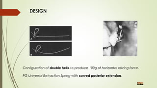 DESIGN
Configuration of double helix to produce 100g of horizontal driving force.
PG Universal Retraction Spring with curved posterior extension.
 