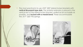  The most practical is to use .018"´.025" lateral incisor brackets with
vertical Broussard-type slots. The anterior extension is placed in the
vertical slot of the lateral incisor bracket, pulled as far occlusally as
possible, and locked with a mesial bend. These accommodate
the .017"´.025" PG springs.
 