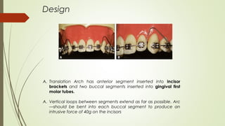 A. Translation Arch has anterior segment inserted into incisor
brackets and two buccal segments inserted into gingival first
molar tubes.
A. Vertical loops between segments extend as far as possible. Arc
—should be bent into each buccal segment to produce an
intrusive force of 40g on the incisors
Design
 