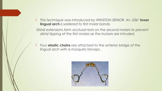  This technique was introduced by WINSTON SENIOR. An .036" lower
lingual arch is soldered to first molar bands.
Distal extensions form occlusal rests on the second molars to prevent
distal tipping of the first molars as the incisors are intruded.
 Four elastic chains are attached to the anterior bridge of the
lingual arch with a mosquito forceps .
 