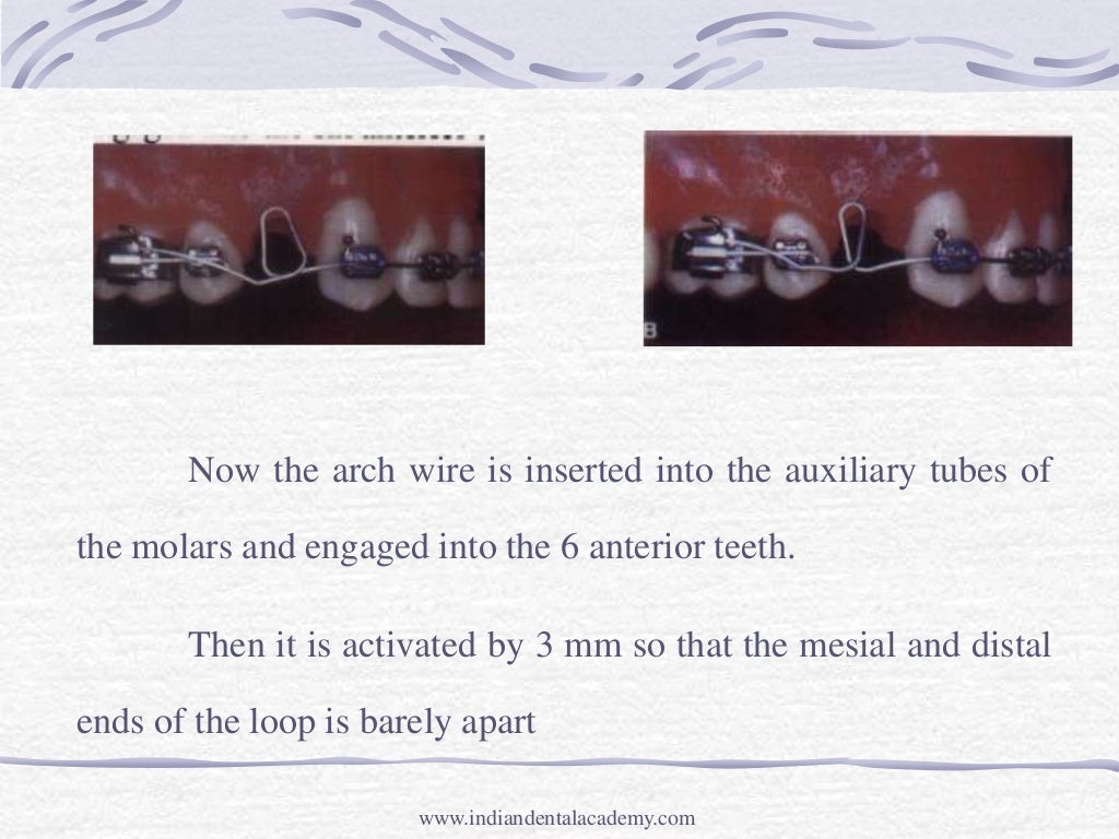 Intrusion mechanic and appliances /certified fixed orthodontic course…