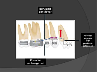 Posterior
anchorage unit
Intrusion
cantilever
Anterior
segment
with
posterior
extension
 