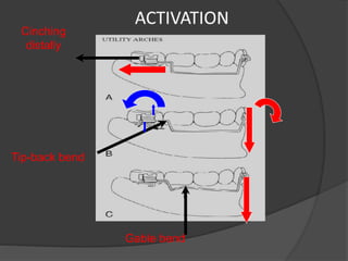 Gable bend
Cinching
distally
Tip-back bend
 