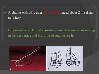• Archwire with off-center 60° V-bend placed about 2mm distal
to U-loop.
• Off-center V-bend creates greater moment on molar, increasing
molar anchorage and intrusion of anterior teeth.
 