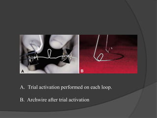 A. Trial activation performed on each loop.
B. Archwire after trial activation
 