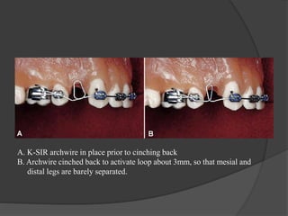 A. K-SIR archwire in place prior to cinching back
B. Archwire cinched back to activate loop about 3mm, so that mesial and
distal legs are barely separated.
 
