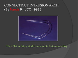 CONNECTICUT INTRUSION ARCH
(By Nanda R, JCO 1998 )
The CTA is fabricated from a nickel titanium alloy
 