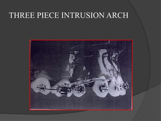 THREE PIECE INTRUSION ARCH
 