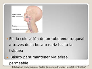 Intubación endotraqueal | PPTX