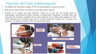 intubacion.pptx