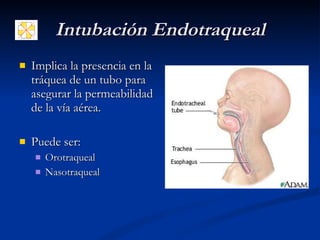 Intubación Endotraqueal Implica la presencia en la tráquea de un tubo para asegurar la permeabilidad de la vía aérea. Puede ser: Orotraqueal Nasotraqueal 