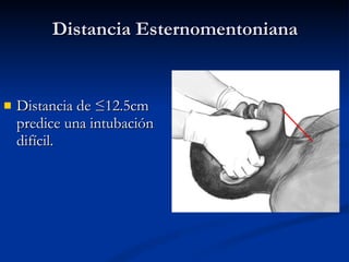 Distancia Esternomentoniana Distancia de ≤12.5cm predice una intubación difícil. 