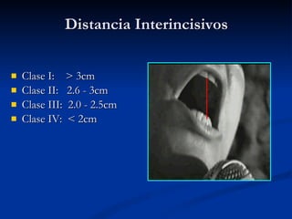 Distancia Interincisivos Clase I:  > 3cm  Clase II:  2.6 - 3cm  Clase III:  2.0 - 2.5cm  Clase IV:  < 2cm  