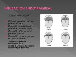 Clasificación de CormackLehane.