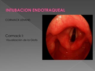 Distancia tiromentoniana.